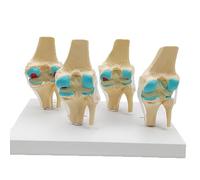 1 modelo de anatomía de la articulación de la rodilla patológica humana de cuatro etapas, recursos de enseñanza de ciencias médicas, envío directo