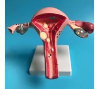 1 modelo de ovario y útero patológico humano, estructura de sección transversal, modelo de anatomía anatómica del útero, herramienta de estudio y enseñanza de órganos femeninos