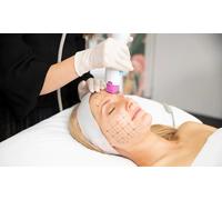 1 sesión de tratamiento rejuvenecedor con radiofrecuencia última generación efecto lifting (45 minutos)