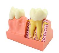 10 Modelo de anatomía Dental Modelo de Dientes Modelo de enseñanza 4X Modelo de descomposición del Diente Modelo de demostración del Diente para la educación del Paciente