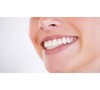 2 implantes de titanio con higiene bucal con ultrasonidos y radiografía panorámica