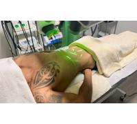 2 sesiones de liposucción sin cirugía con Láser Emerald