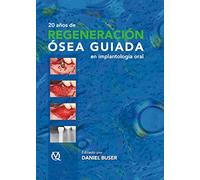 20 años de regeneración ósea guiada en implantología