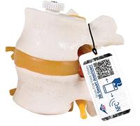 3B Scientific A76/9 Modelo de Anatomía Humana Discos Lumbares, con Hernia Discal Montados Flexibles + Software de Anatomía Gratuito - 3B Smart Anatomy, 2 Lumbares, con Hernia Disca