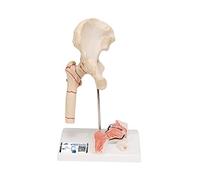 3B Scientific A88 Modelo de anatomía humana Fractura de Fémur y desgaste de la Articulación de la Cadera + App de anatomía gratuita - 3B Smart Anatomy