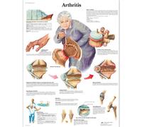 3B Scientific Anatomía humana - Carta de artritis, versión laminada