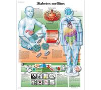 3B Scientific Anatomía humana - Diabetes Mellitus Gráfico, Versión en papel