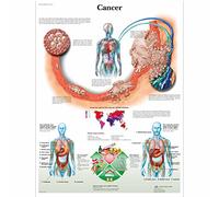 3B Scientific de cáncer de mama guía de posición de