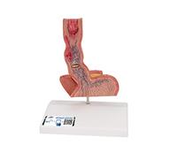 3B Scientific K18 Modelo de anatomía humana Enfermedades del Esófago + App de anatomía gratuita - 3B Smart Anatomy