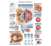 3B Scientific - Lámina Plastificada de las Enfermedades del Ojo - Póster de Anatomía y Patología Protegido contra UV y Polvo para Estudio, Enseñanza y Clínicas