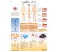 3B Scientific - Lámina Plastificada de las Úlceras por Decúbito - Póster de Patología Protegido contra UV y Polvo para Estudio, Enseñanza y Clínicas