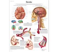 3B Scientific - Lámina Plastificada del Accidente Cerebrovascular - Póster de Anatomía y Patología Protegido contra UV y Polvo para Estudio, Enseñanza y Clínicas