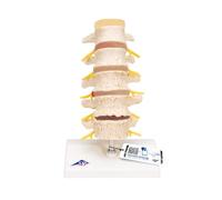 3B Scientific® Modelo de Columna Lumbar - Vértebras Lumbares a Tamaño Real con Etapas de Hernia Discal & Degeneración Vertebral + Smart Anatomy App (Garantía de 5 Años)