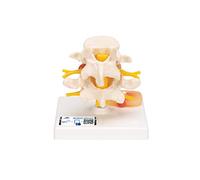 3B Scientific® Modelo de Vértebras Lumbares - 2 Vértebras a Tamaño Real con Disco Intervertebral y Demostración de Hernia Discal + Smart Anatomy App (Garantía de 5 Años)