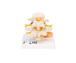 3B Scientific® Modelo de Vértebras Lumbares - 2 Vértebras a Tamaño Real con Disco Intervertebral y Demostración de Hernia Discal + Smart Anatomy App (Garantía de 5 Años)