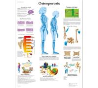 3B Scientific Osteoporosis gráfico, laminado, 1
