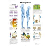 3B Scientific Placa de aprendizaje laminada - osteoporosis VR0121L