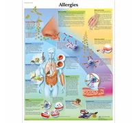 3B Scientific Póster Anatómico del Sistema Inmunológico y las Reacciones Alérgicas, Gráfico Didáctico de los Mecanismos de la Alergia, Gráfico Educativo sobre Alergias
