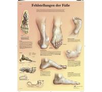 3B Scientific Póster de Desalineaciones del Pie, Tabla Didáctica del Pie Plano, Pie Cavo, Hallux Valgus y Trastornos del Pie, Póster Educativo sobre Deformidades del Pie