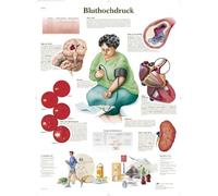 3B Scientific - Póster explicativo sobre la hipertensión (en alemán), 1