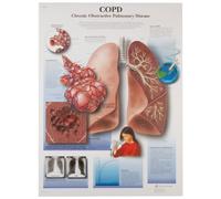3B Scientific - Tabla de enfermedades pulmonares obstructivas crónicas, Sin laminar