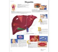 3B Scientific - Tabla De Hepatitis, Laminado, 1