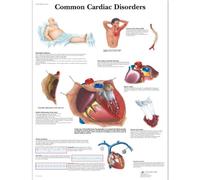 3B Scientific - Tabla De Trastornos Cardíacos Comunes, Laminado, 1