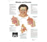 3B Scientific Tabla didáctica - rinitis y sinusitis