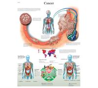3B Scientific Temporada educativa laminada - Cancer - Inglés