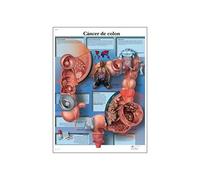 3B Scientific VR3432L Impreso En Papel, Cáncer de Colon