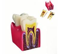 6 veces la caries dental modelo de enseñanza Typodont herramienta para dentistas, pacientes, profesores y estudiantes que estudian e investigan (extracción de dientes)