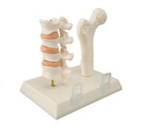 ACOGEDO Modelo de Columna de Osteoporosis Educativa que Demuestra Cambios Patológicos en los Tejidos Vertebrales con Diseño Realista para la Enseñanza Clínica en Anatomía y Entornos de Atención Médica