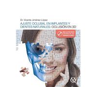 AJUSTE OCLUSAL EN IMPLANTES Y DIENTES NATURALES: OCLUSION EN 3D