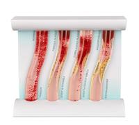 Akfldms Modelo de Vaso Sanguíneo Herramienta de Enseñanza y Entrenamiento Modelo Vascular de 4 Etapas Herramienta de Enseñanza y Entrenamiento de Enfermedades