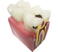 AMOYER Modelo de Dientes de Caries Dental: Modelo de educación de anatomía ampliada 6X, Estudio de comparación Bilateral de Caries, demostración de sección Transversal para Herramientas de enseñanza