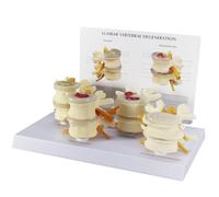 AMQYDT Modelo comparativo de Lesiones de Columna Lumbar en 4 etapas, Modelo de Columna Humana con Tarjeta en inglés, Muestra Hernia discal, degeneración ósea y discal, y osteoporosis Avanzada