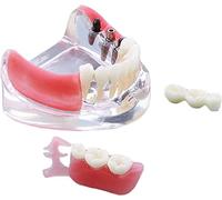 AMZBNEIDI Modelo anatómico del Torso Humano, Modelo de restauración de implantes dentales for enseñanza en escuelas de odontología con Dientes Removibles