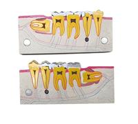 Análisis detallado del modelo de dientes dentales. Modelo de demostración del desarrollo de implantes dentales para la educación dental.
