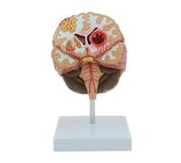Anatomía De La Educación Modelo De Anatomía del Cerebro Humano, Hemorragia Cerebral para Investigación Científica En El Aula Y Demostración Enseñanza Muñeca de Anatomía