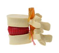 Anatomía humana, esqueleto, columna vertebral, disco lumbar, hernia, modelo de enseñanza, lesiones espinales, herramienta de enseñanza médica