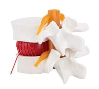 Anatomía Humana, Modelo de Demostración de Hernia de Disco Lumbar, 1:1.5 Modelo de Columna Vertebral Lumbar para Demostración Médica