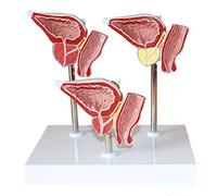 Anatomía médica del modelo de Prostataläsion humana Des sistema urinario modelo anatómico ayuda médica 20 * 15 * 12cm