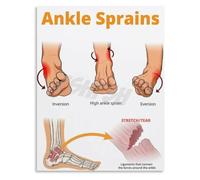 Ankle Sprains Educational Poster Anatomy Injury Prevention Wall Art Classroom Decor