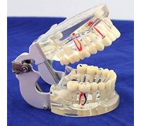 asdchZen Modelo De Patología Dental, Modelo De Caries Dental, Modelo Transparente para Adultos, Modelo Integral De Demostración De Patología Oral, Material De Apoyo para La Formación Médica.