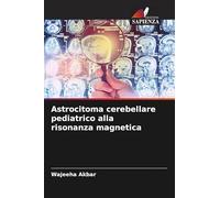Astrocitoma cerebellare pediatrico alla risonanza magnetica