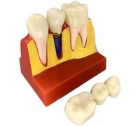 Baokuan Modelo De Implante Dental: Análisis Removible 4 Veces Demostración De Puente De Modelo De Dientes Análisis De Implante Dental Modelo De Diente para Aprendizaje Y Educación