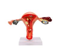 Brrnoo Modelo Anatómico del Ovario del útero Patológico Femenino Modelo de Anatomía del útero Humano de PVC para Estudio Educativo Enseñanza Educativo de Enfermería para Biología