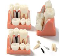 buyzg Modelo de implante Dental de 3 Piezas, Corona y Puente Desmontables de 4 Piezas para presentaciones, educación, enseñanza, Cuidado Dental, Modelos médicos.