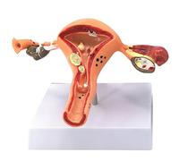 buyzg Modelo de Ovario y útero Femenino Patología Útero Humano Ovario Enfermedad Disección Biología Material didáctico Anatomía Modelo de lesión