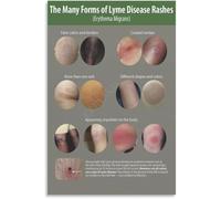 BYLSAGWHT Prevent Lyme Disease Poster Tick Bite Outdoor Protection Wall-Art Canvas for Bedroom Home Office Decor(Framed,16x24inch(40x60cm))
